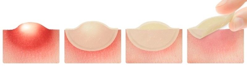 Elizavecca Witch Piggy Hell-Pore Blemish Spot Patch.jpg
